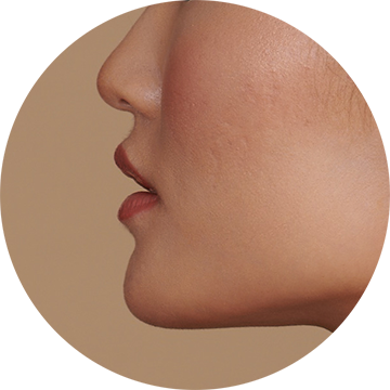 acne-scars