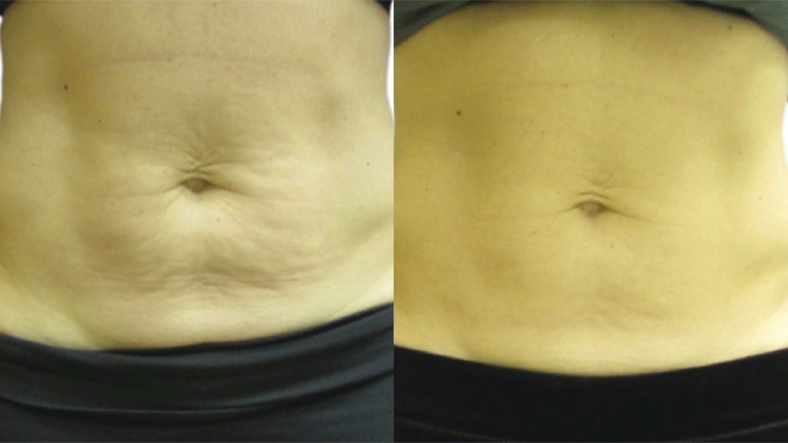 body-tight-before-after-1