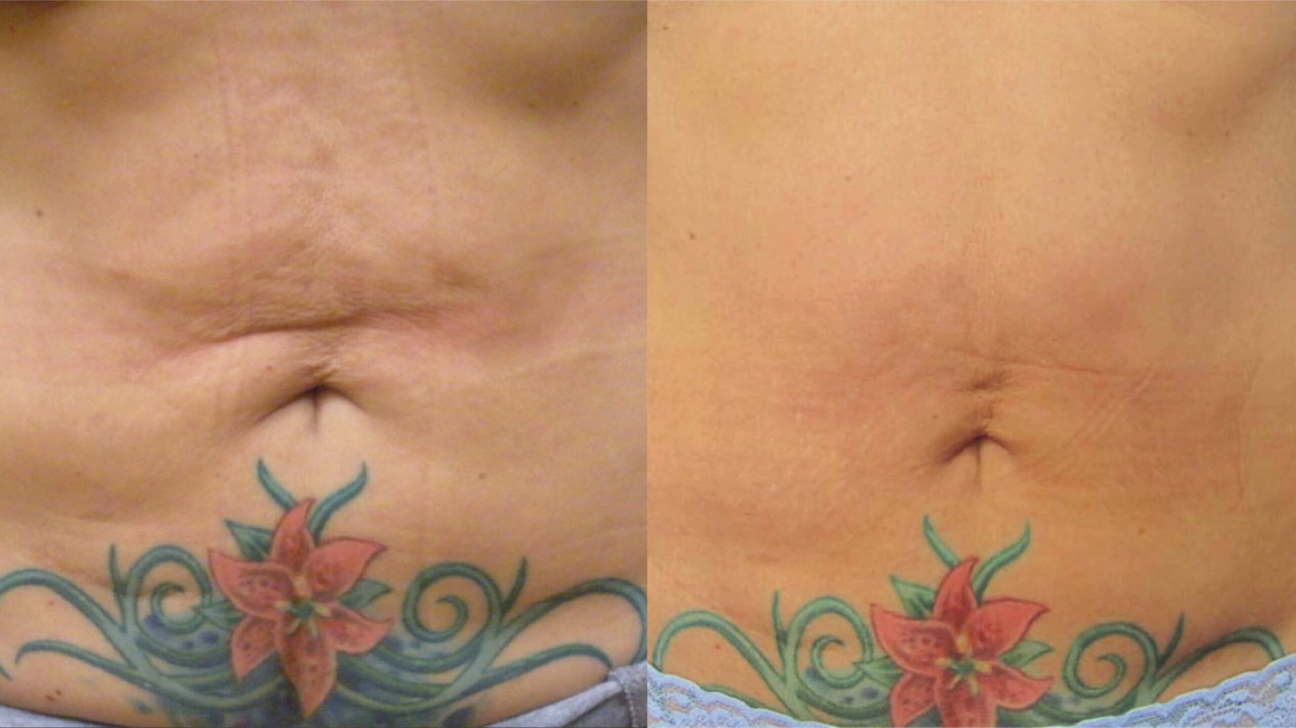 body-tight-before-after-2
