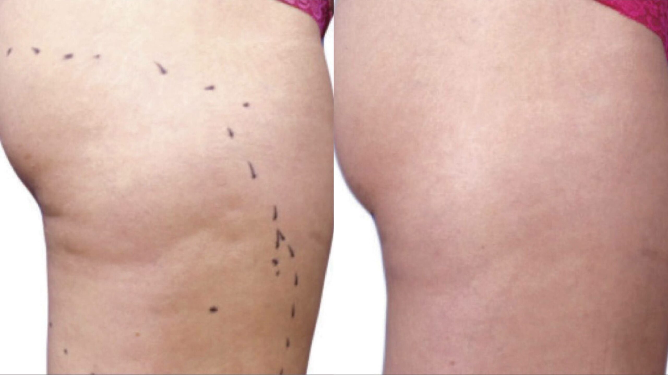 body-tight-before-after-3
