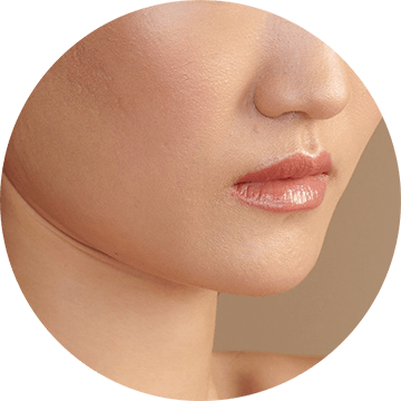 active-acne-image