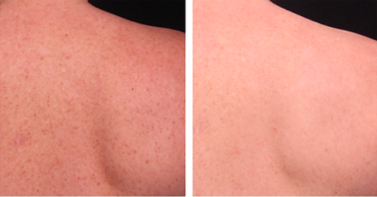 body-glow-before-after-3
