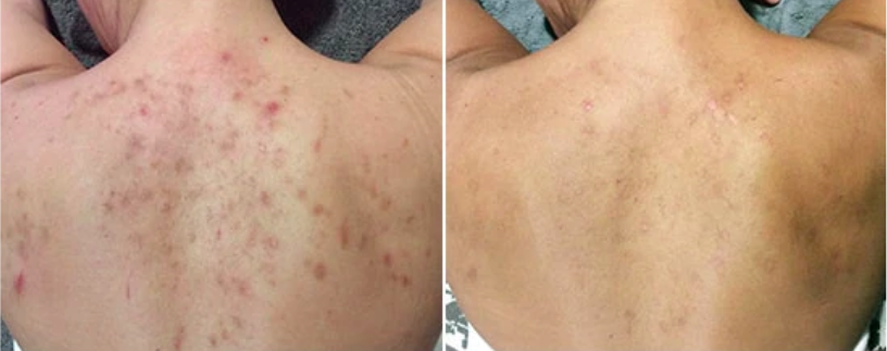 body-peel-before-after