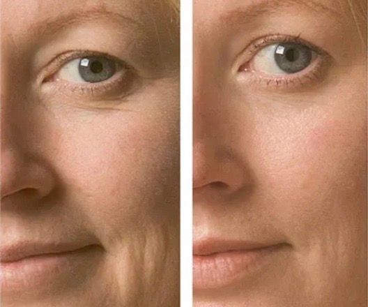 hydra-quench-before-after
