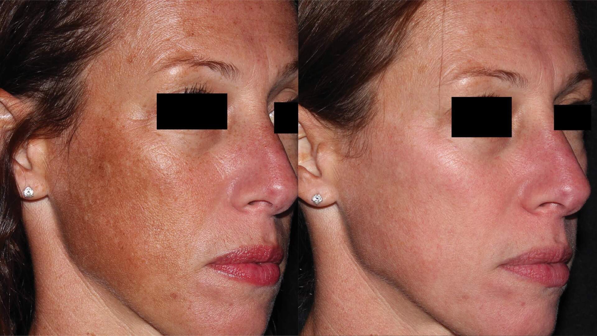 pico-sure-before-after-1