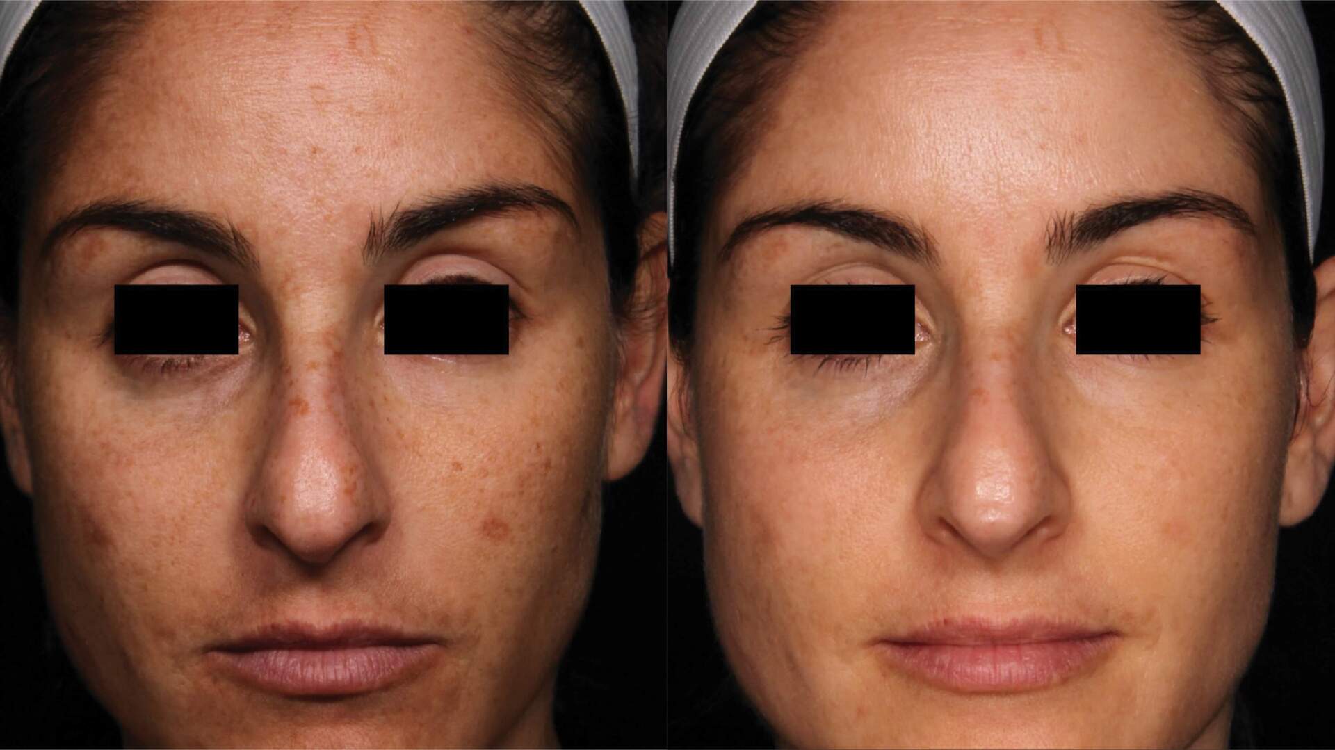 pico-sure-before-after-2