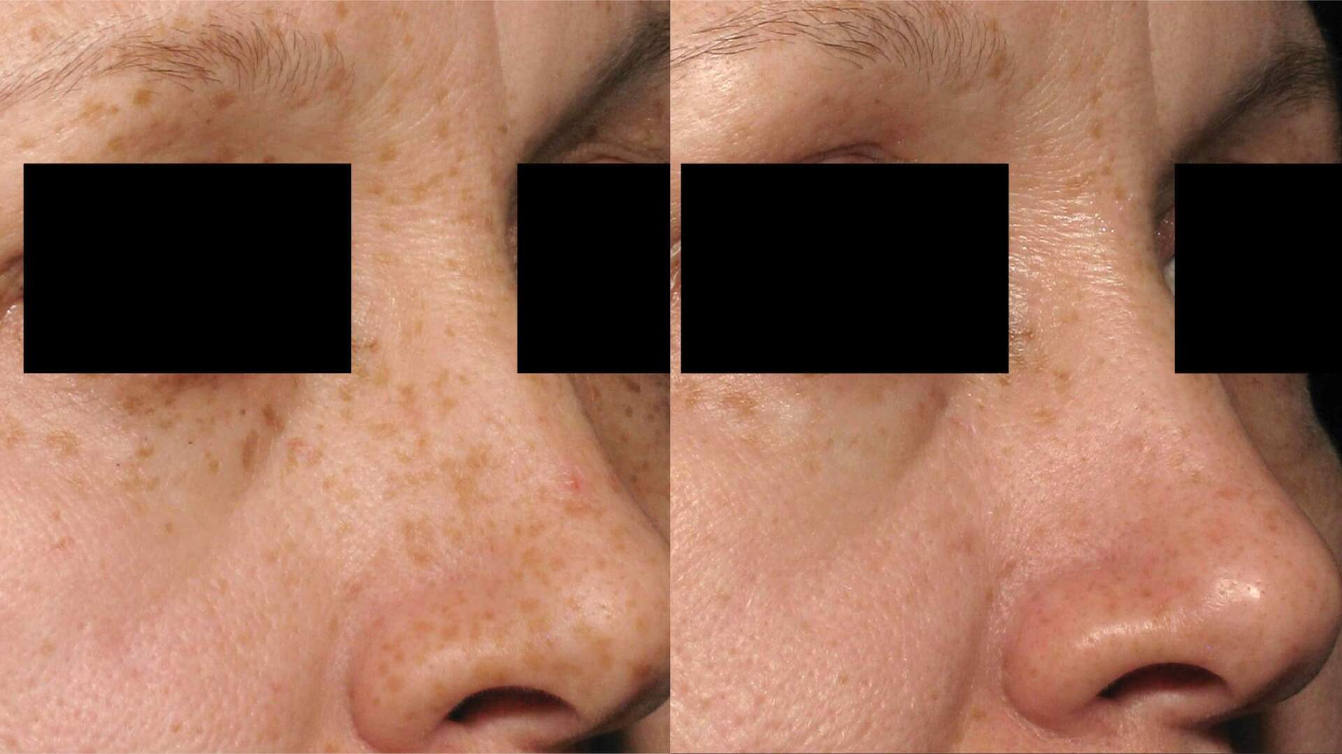 pico-sure-before-after-3
