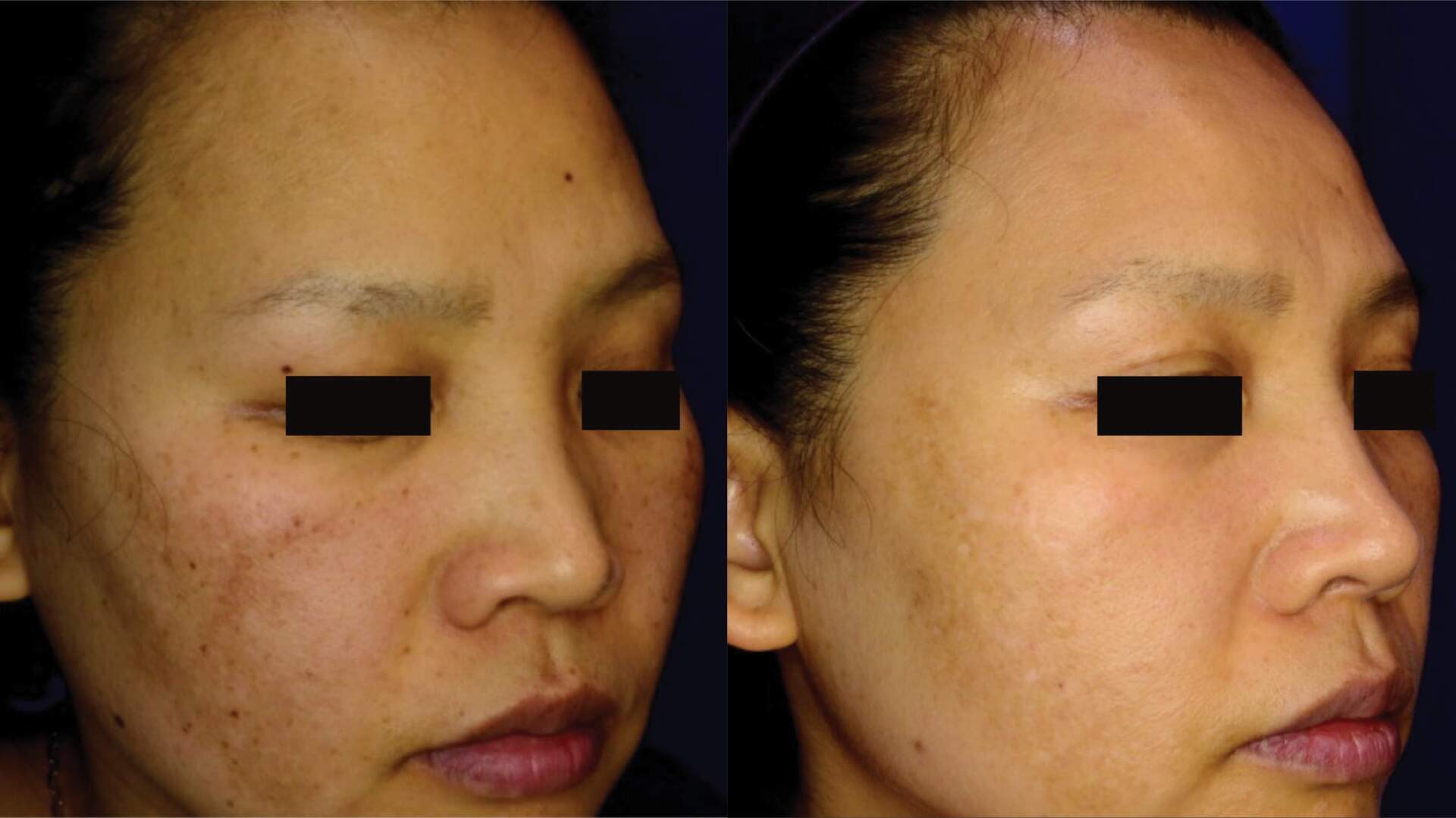 pico-sure-before-after-4