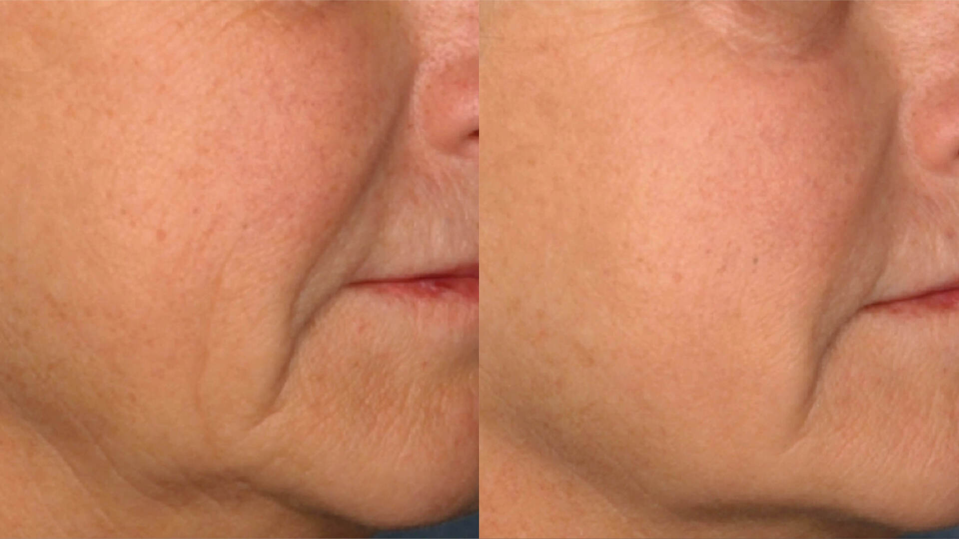 pico-sure-before-after-5
