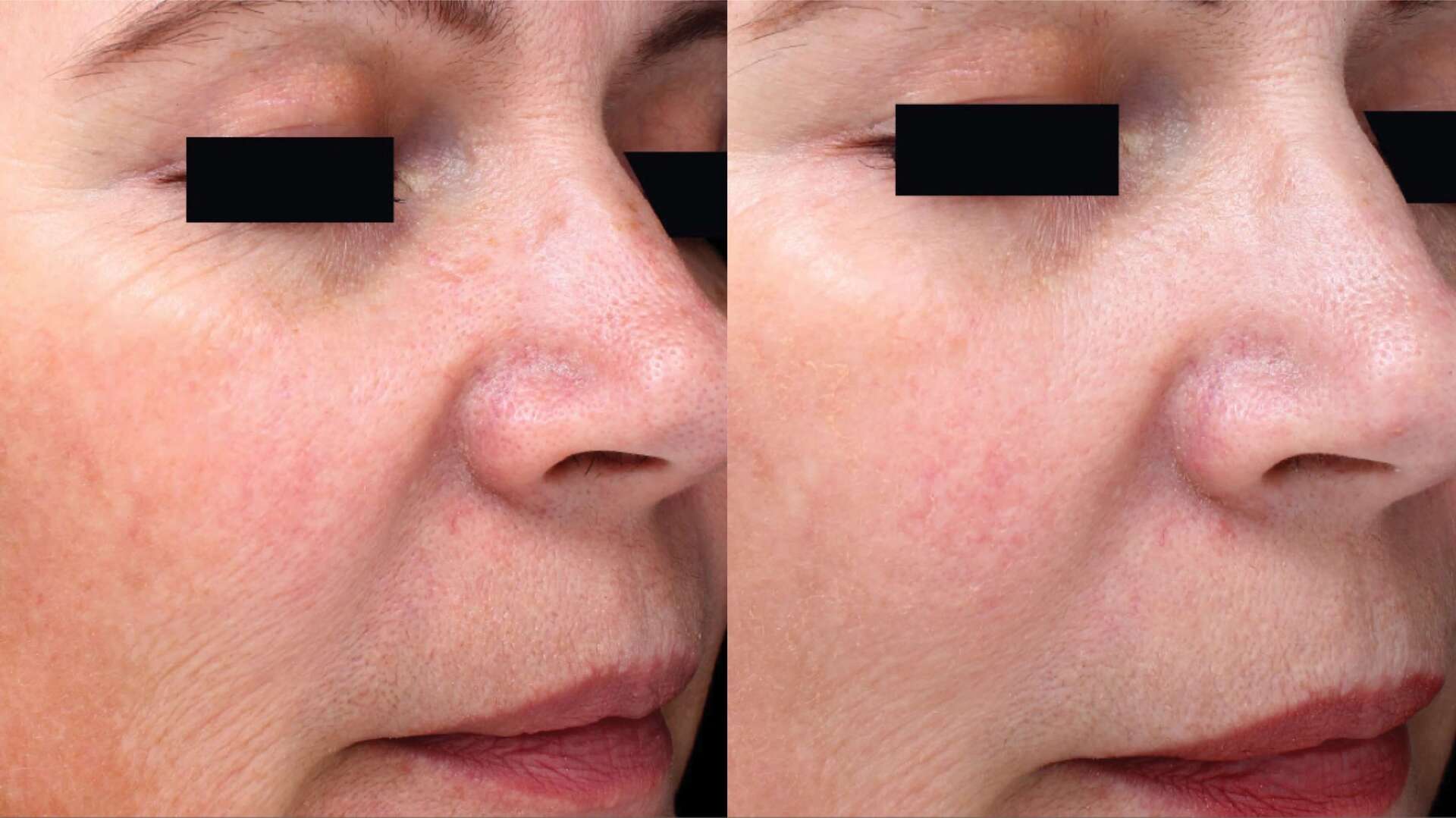pico-sure-before-after-6