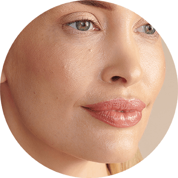 rosacea-image