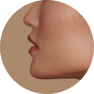 acne-scars-image