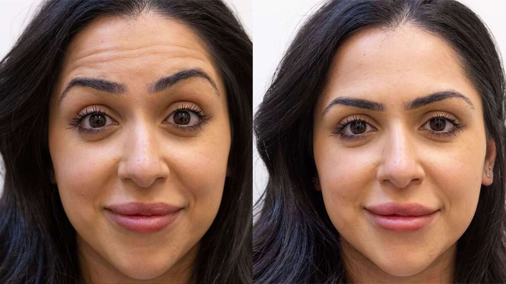 botox-before-after (1)