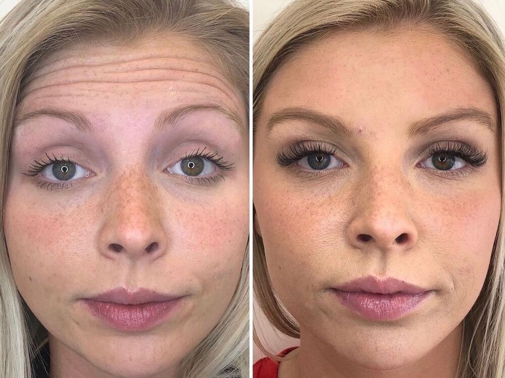 botox-before-after-1
