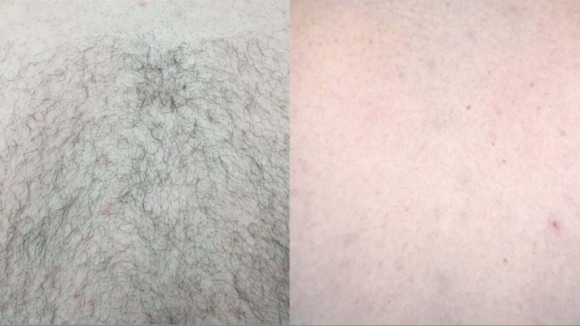 laser-hair-removal-before-after-1
