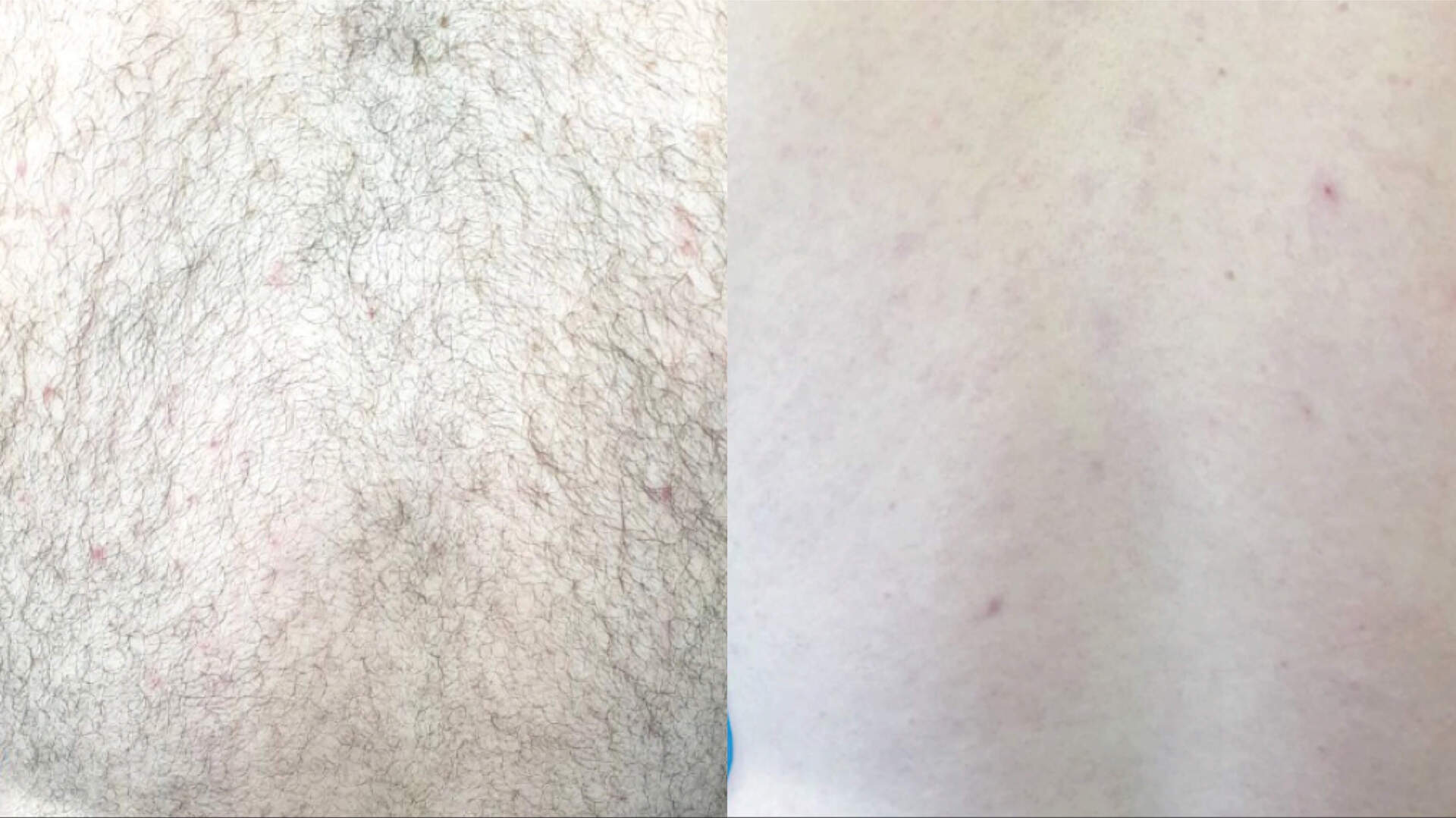laser-hair-removal-before-after-2