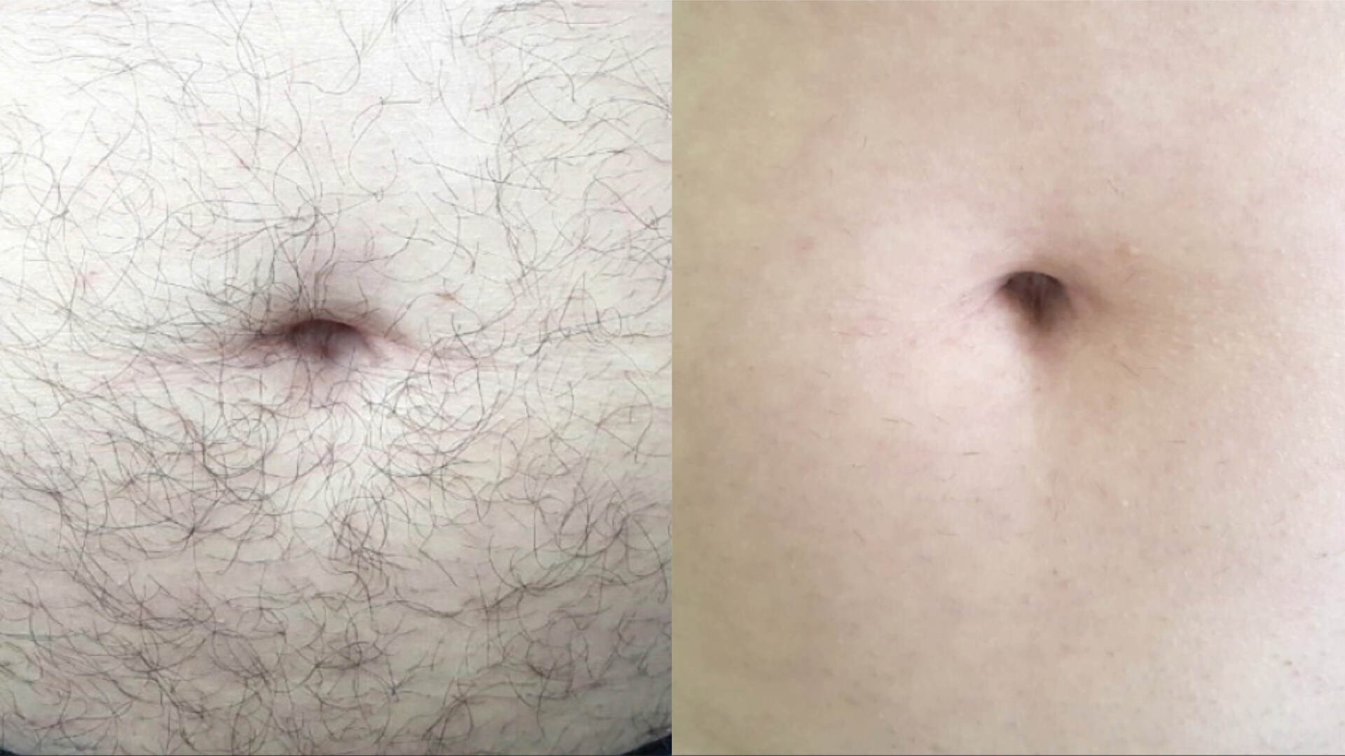 Caesarean section scars and laser hair removal 
