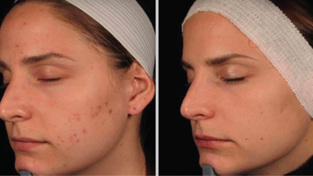 promotions-before-after-power-peel