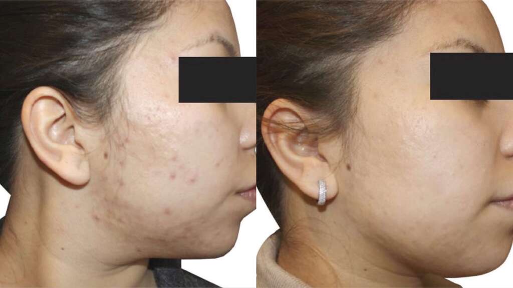 promotions-before-after-skin-glow