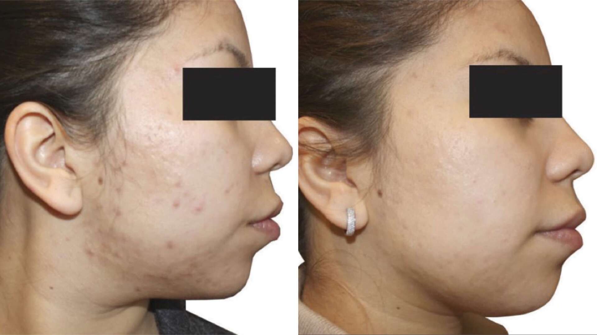 skin-glow-before-after-1
