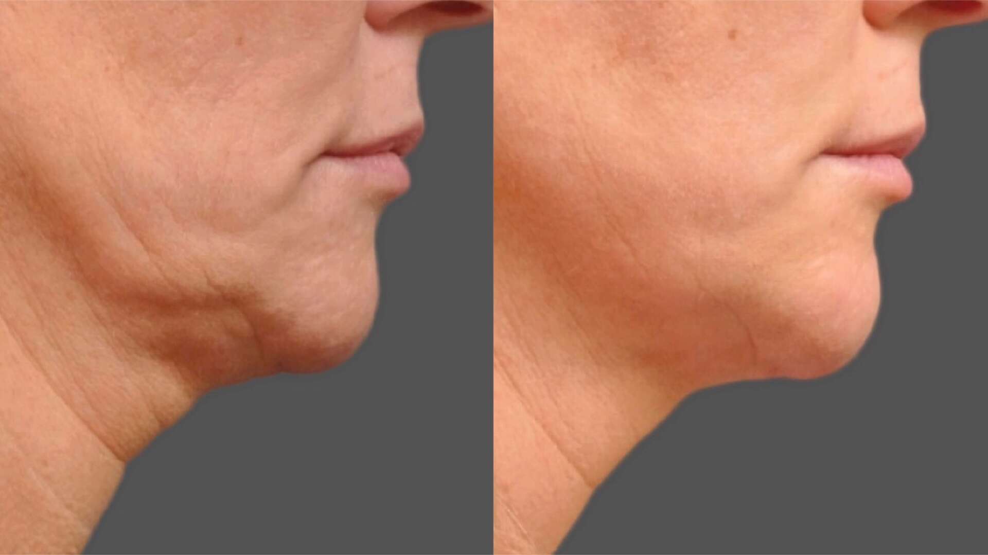 ultherapy-before-after-1