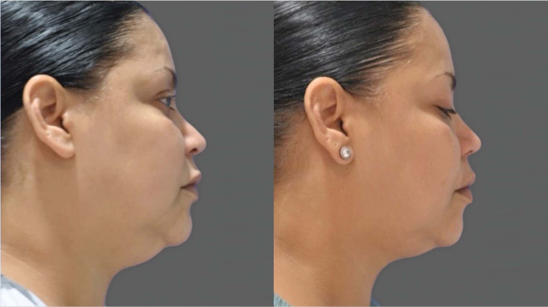 ultherapy-before-after-2