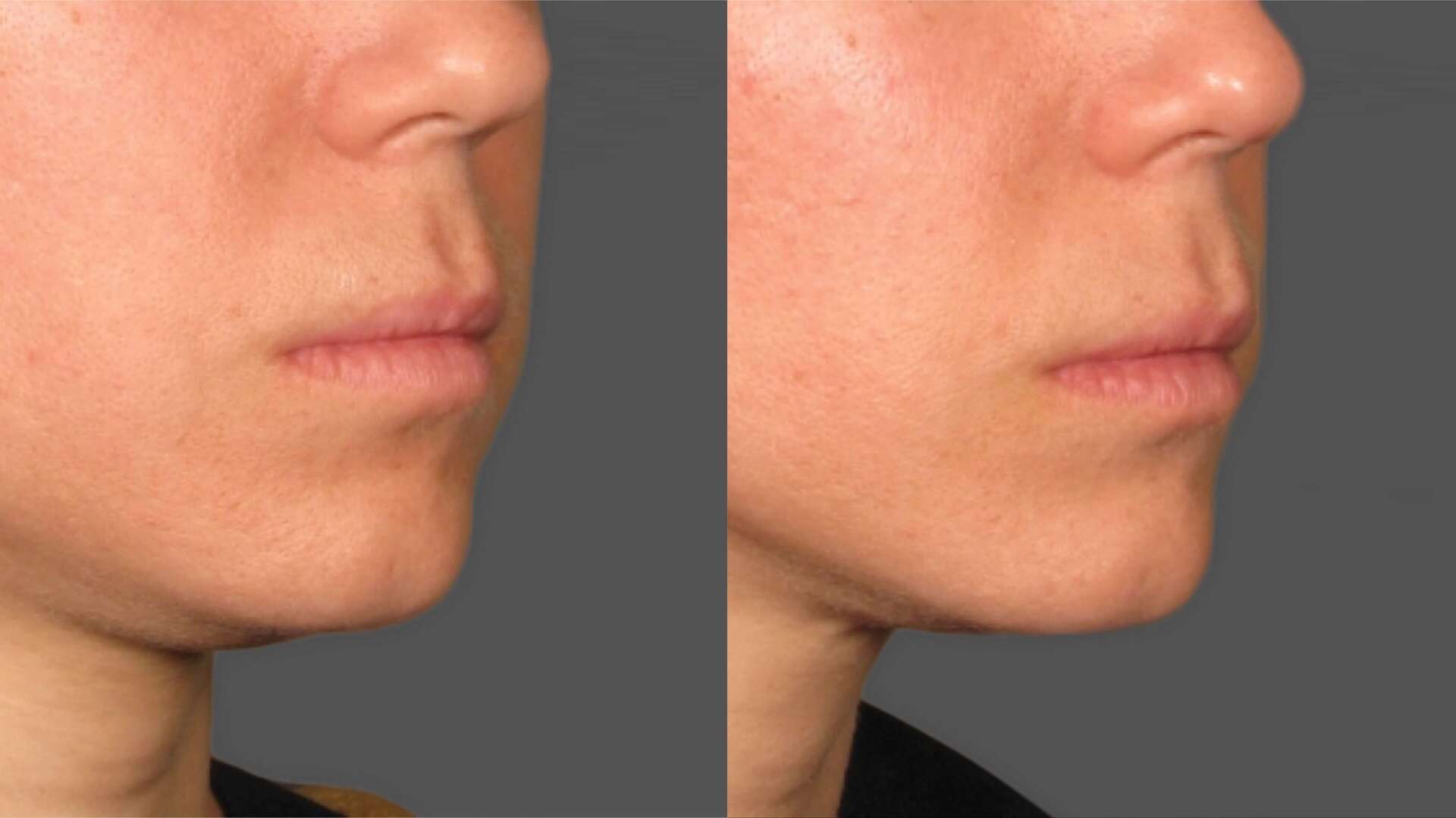 ultherapy-before-after-3