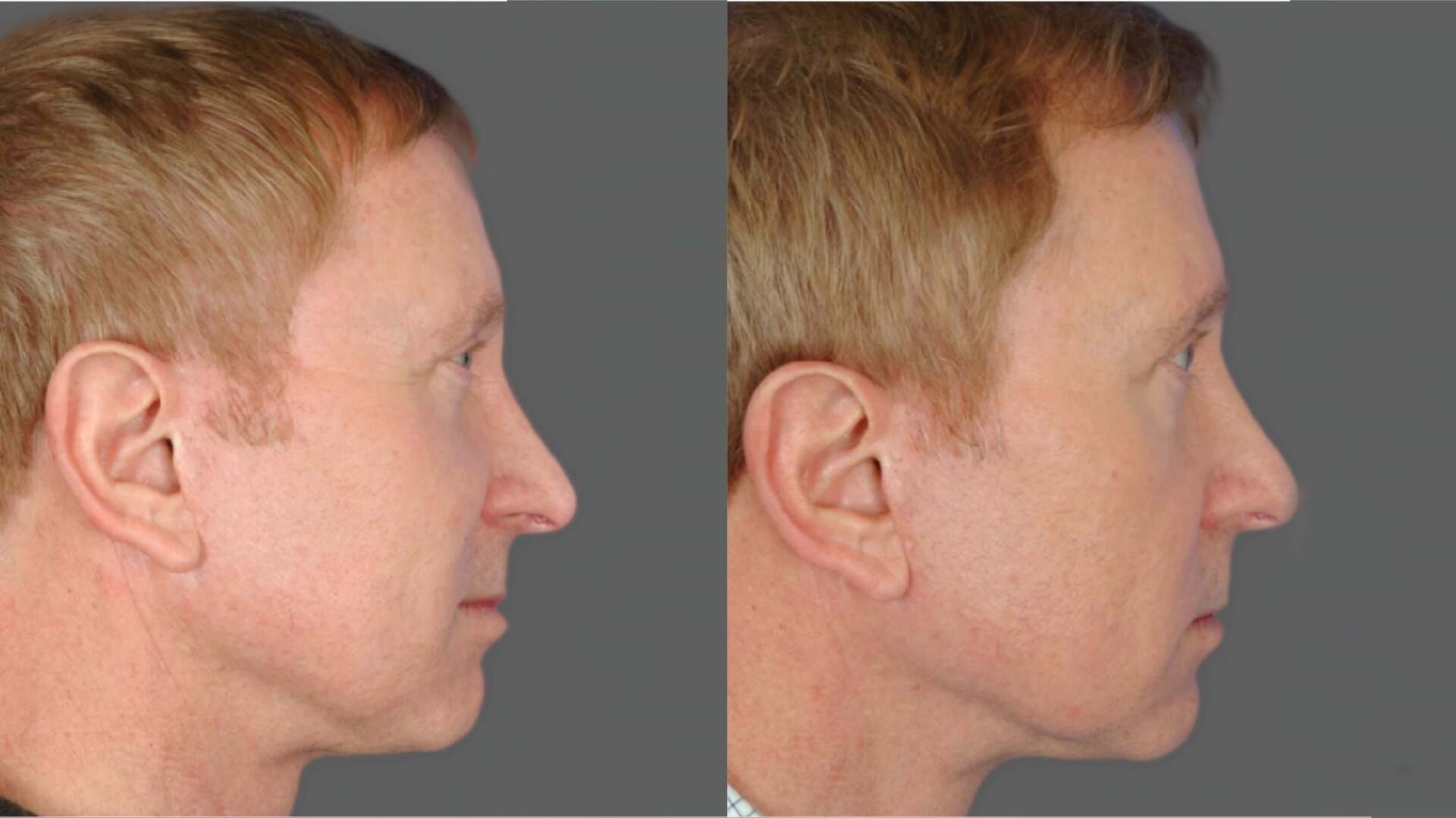 ultherapy-before-after-4